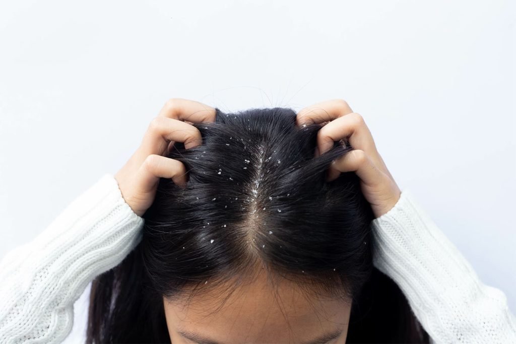 dermatite seborreica