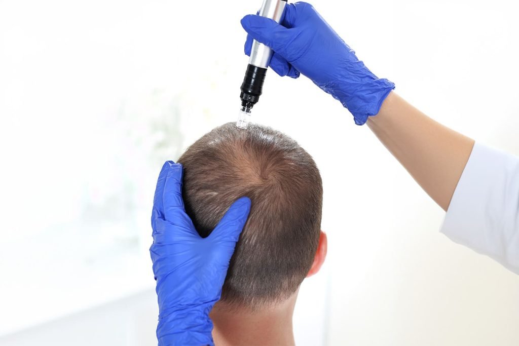 Microagulhamento com Drug-Delivery