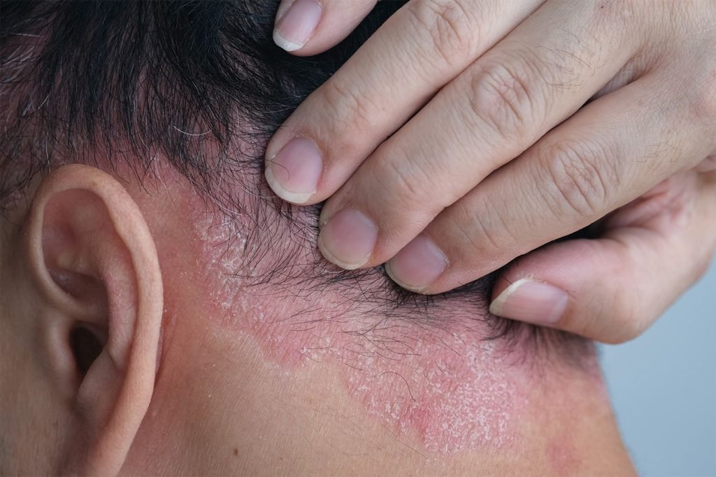 psoríase capilar