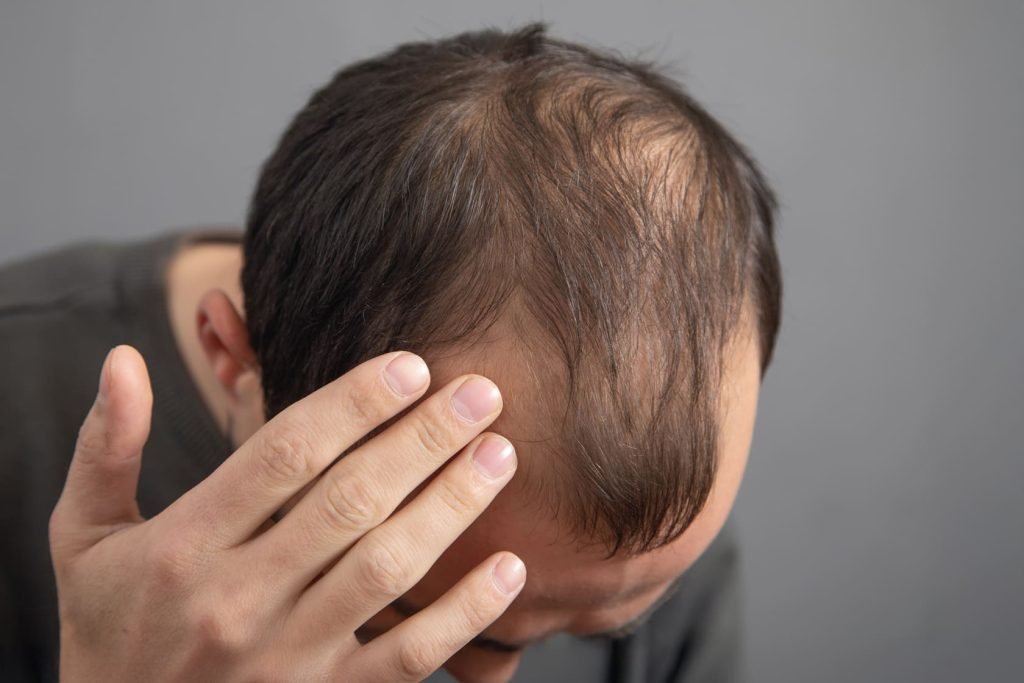 Tratamento para calvície masculina