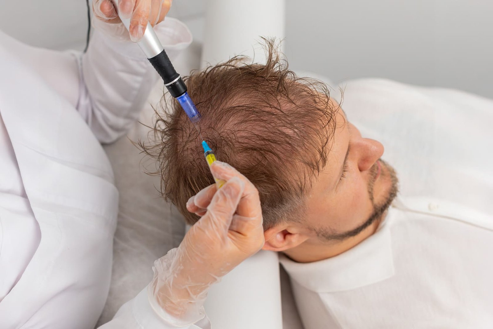 tratamentos para calvicie