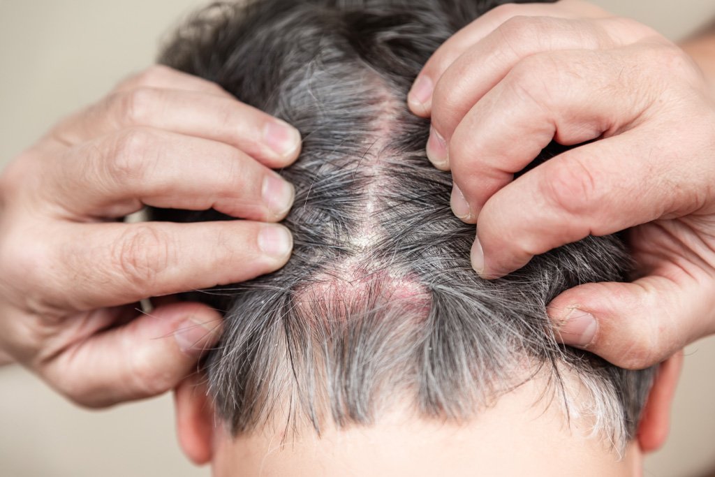 Inflamação no couro cabeludo