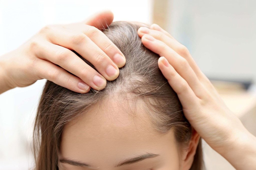 O que é Alopecia Frontal Fibrosante e como Tratar?