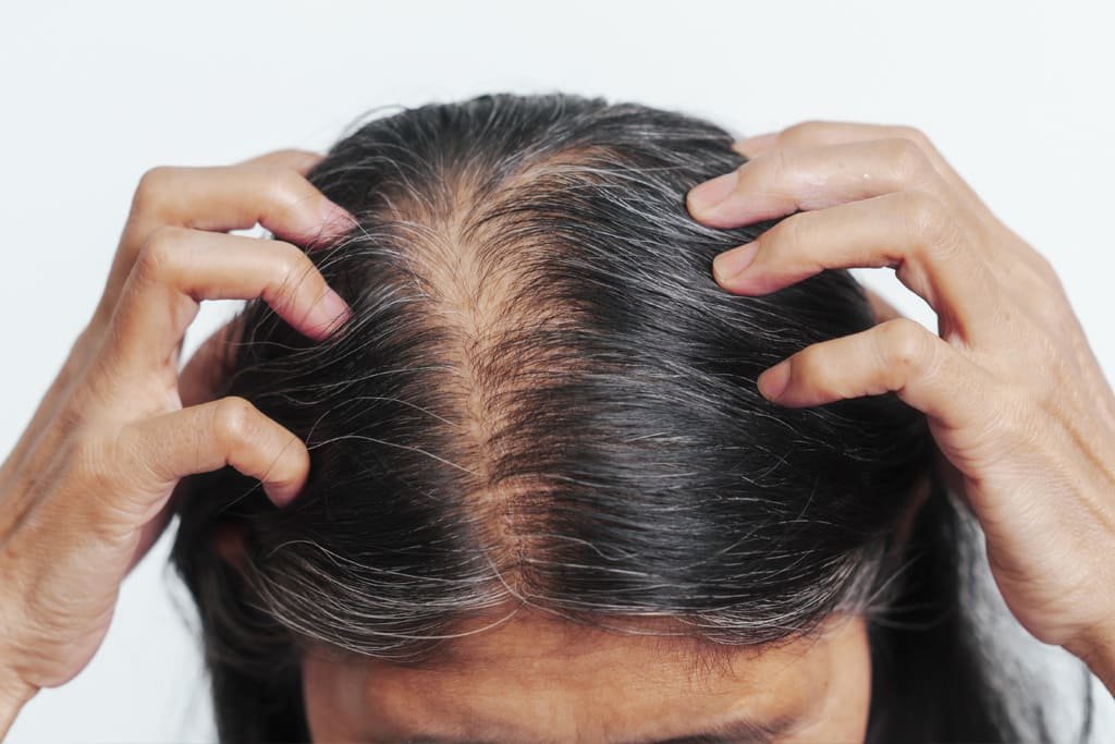 Alopecia senil
