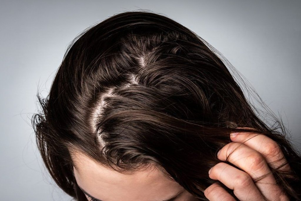 Cabelo Oleoso pode causar queda de Cabelo?