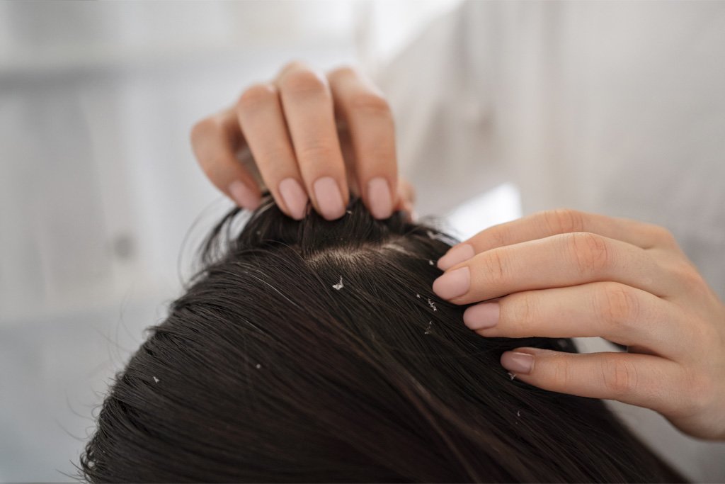 Dermatite Seborreica no Couro Cabeludo: Causas e Tratamento